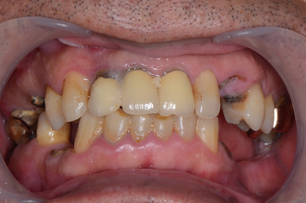 セラミックブリッジと金属床義歯の組み合わせ症例